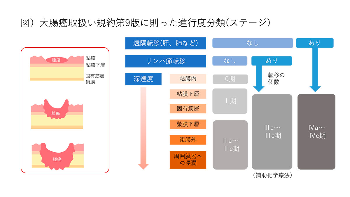 大腸癌取り扱い規約第9版に則った新高度分類（ステージ）