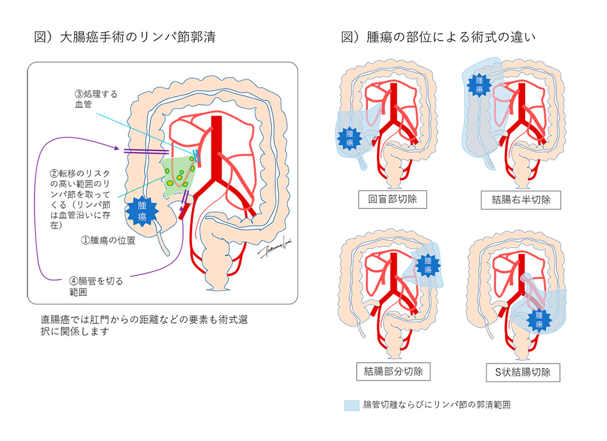 大腸癌手術のリンパ節郭清・腫瘍の部位による術式の違い
