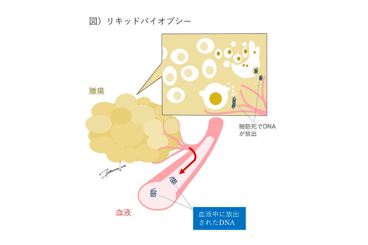 リキッドバイオプシー