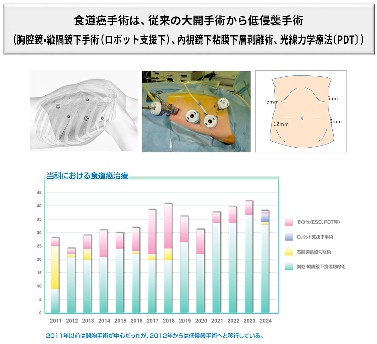 食道癌手術は、襲来の大開胸手術から低侵襲手術（鏡視下手術,内視鏡的粘膜下層剥離術）へ