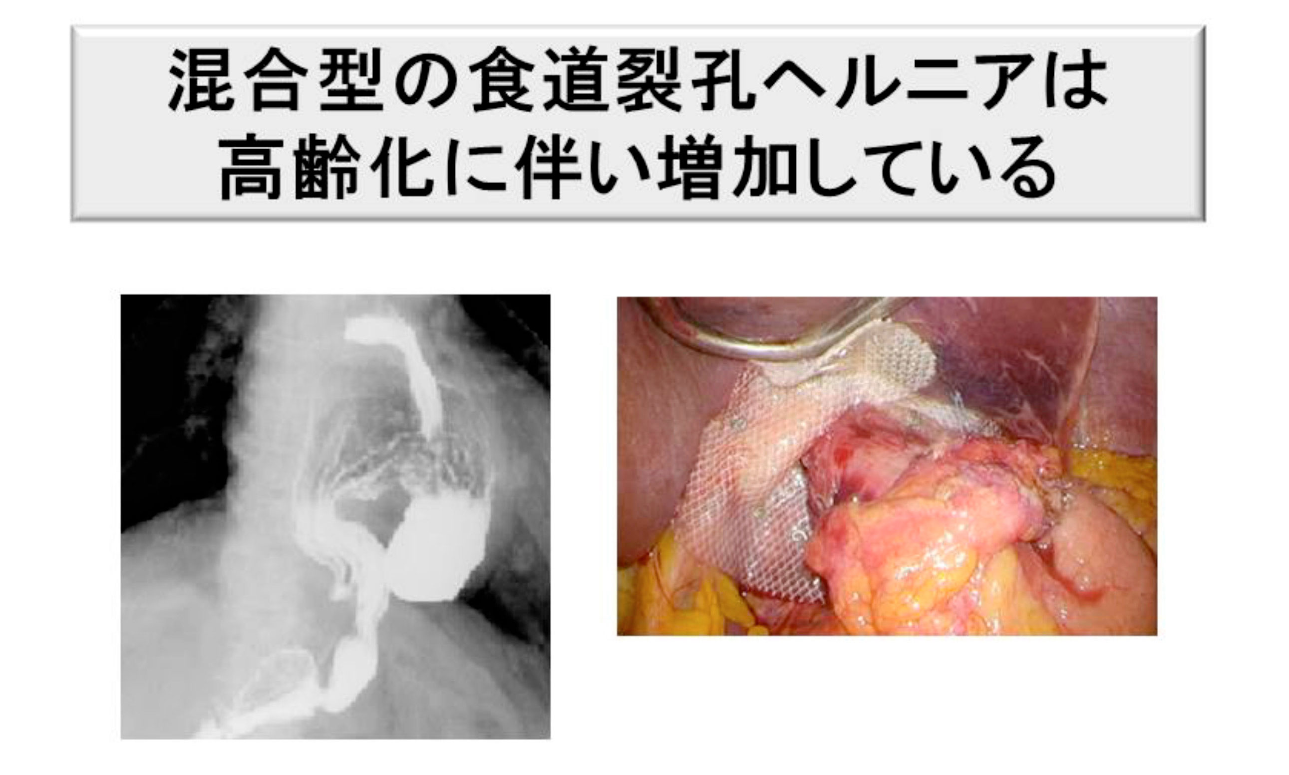 混合型の食道裂孔ヘルニアは高齢化に伴い増加している