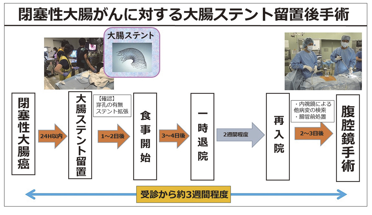 閉塞性大腸がんに対するステント留置後手術